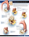Minimally-invasive Modified Nicks Procedure for the Repair of a Small Aortic Root