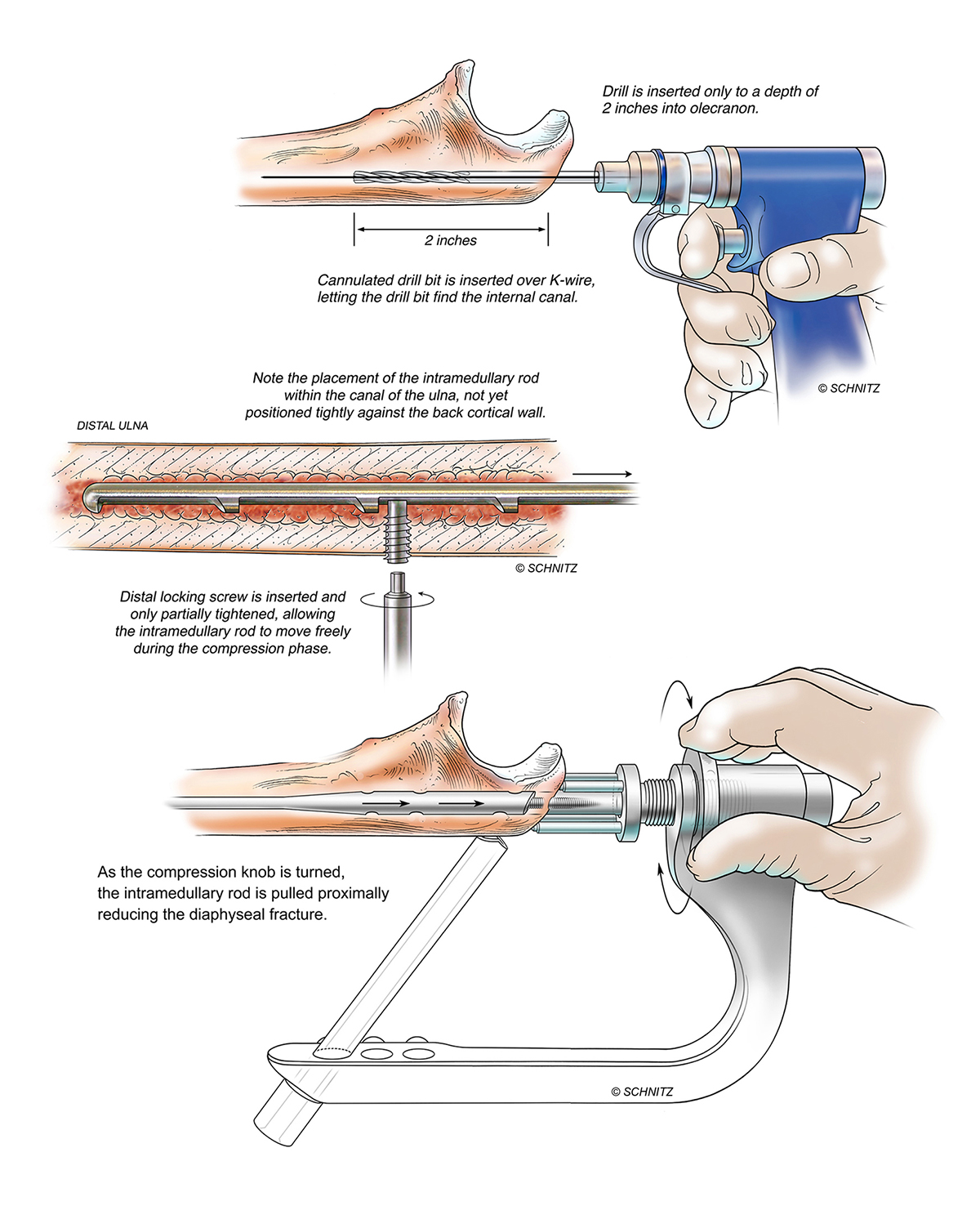 SCHNITZ elbow illustration