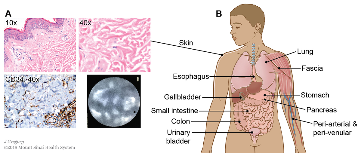 An interstitial space is found in the dermis and submucosae and other fibroconnective tissues throughout the body.